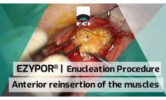EZYPOR | Enucleation | Anterior reinsertion of the muscles - Video