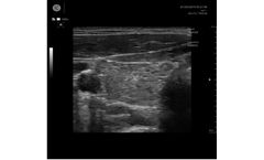 Handheld Ultrasound Devices for Clinical Value - Thyroid