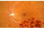 Retinal Vein Occlusion (RVO) - Medical / Health Care