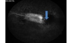 Cerevast - Microsphere-Mediated Ophthalmic Ultrasound