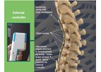 Auctus - Dynamic Scoliosis Tethering System