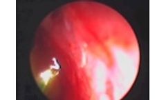Part One, Endoscopic Revisional DCR, 5mm and 9mm LacriCATH, Mark T Duffy, MD PhD - Video