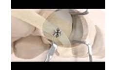 Coronet Soft Tissue Fixation System Kidner Animation from CoNextions Medical - Video