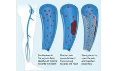 Venous Stent System for Clinical Trial