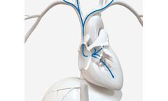 SupraCross - Model Jugular/Subclavian - Steerable Sheath and RF Wire