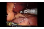 Large Liver in Sleeve Gastrectomy - Video