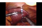 FreeHold Surgical: FreeHold Trio Retractor liver retraction during robotic sleeve gastrectomy - Video