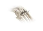 Adductoplasty - Midfoot Correction System