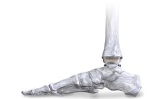 APEX 3D - Total Ankle Replacement System