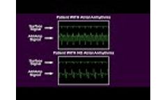 AtriAmp Atrial Electrogram on Bedside Monitor (Atrial Arrhythmia and Sinus Rhythm) - Video
