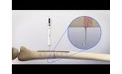 Electronic Depth Gauge (EDG) - for Orthopedic Surgical Fracture Repair - Video
