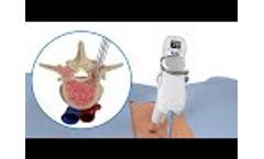 EDGe Surgical, Inc. - Awl-in-one-Tap (AIOT) Animation Spine. Digital Depth Measurement, EMG, Disp - Video