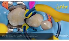 Restoration of a primary molar with myClip Junior. Clinical Case by Dr. Marina Papachroni - Video