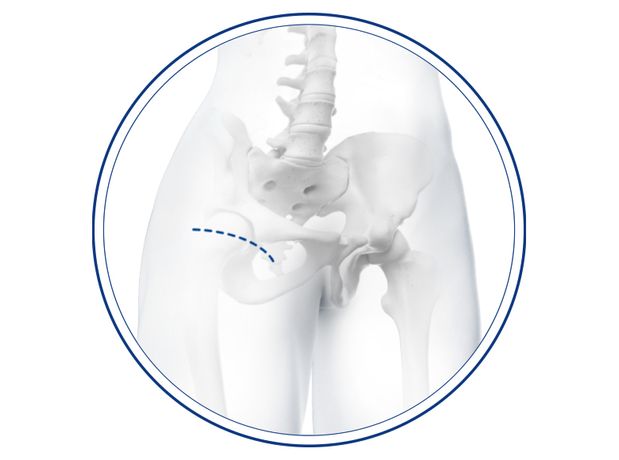 Medacta - Model BIKINI - Anterior Minimally Invasive Surgical Hip Replacement Joint (AMIS)