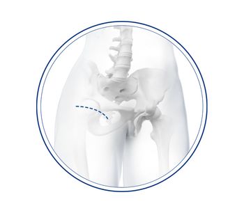 Medacta - Model BIKINI - Anterior Minimally Invasive Surgical Hip Replacement Joint (AMIS)