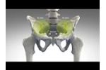 Sacroiliac Joint Fusion with the iFuse Implant System - Video