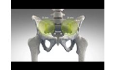 Sacroiliac Joint Fusion with the iFuse Implant System - Video