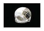 AnatomicsAcrylic - Cranial Implant
