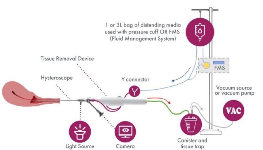 Benesta - Benesta System - Hysteroscopic Tissue Removal System By ...