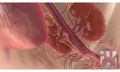 Red Vascular Branch Endograft System: Aortic Aneurysm - Video