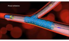 IN Search Avatar image Main Branch Bifurcation Stent (`PROVISIONAL`) by Advanced Bifurcation Systems - Video