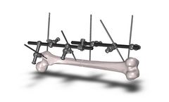 MedSpark - Large Bone External Fixation System