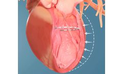 Ancora Accucinch - Ventricular Restoration System for Patients