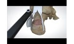 OSSIOfiber Suture Anchor Animation - Video