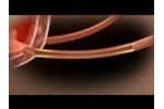 Demo of the Allium Ureteral Stent (URS) - Video