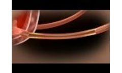Demo of the Allium Ureteral Stent (URS) - Video