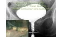 Round Posterior Urethral Stent (RPS) Demo  - Video