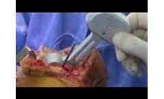 Surgery Video TKR Resume Lospa - Video