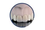 INDURATE - Model ML ET - Multilayer Extra-Translucent for Dental Restoration