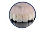 Indurate - Model ML HT - Multilayer High-Translucent for Dental Restoration