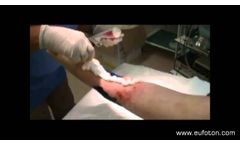 LASEmaR 800 - Wound Healing Photobiomodulation and Debridement - Video