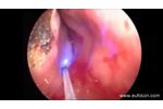 LASEmaR 1000 - ENT Nasal Angioma - ORL Angioma Nasale - Video