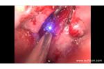 LASEmaR 1000 - ENT Tonsillectomy - ORL Tonsillectomia - Video