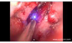 LASEmaR 1000 - ENT Tonsillectomy - ORL Tonsillectomia - Video