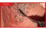 LASEmaR 1500 Treatment of Condylomas, gynaecological laser surgery-trattamento condilomi [Eufoton] - Video