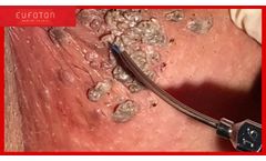 LASEmaR 1500 Treatment of Condylomas, gynaecological laser surgery-trattamento condilomi [Eufoton] - Video