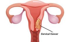 Targeting Cervical Cancer