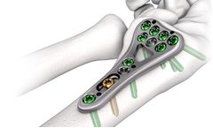 LOQTEQ - Model 2.5 - Distal Radius/Ulna Plates