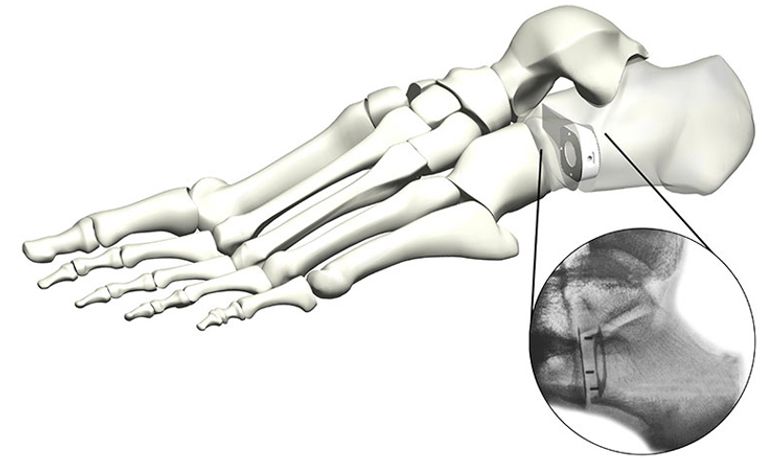 TyWedge - Implant System