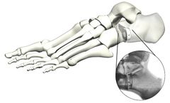 TyWedge - Implant System