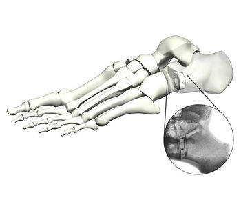 TyWedge - Implant System