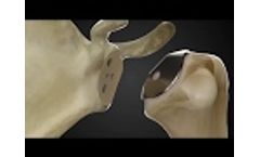 Catalyst Stemless Total Shoulder Replacement Animation - Video