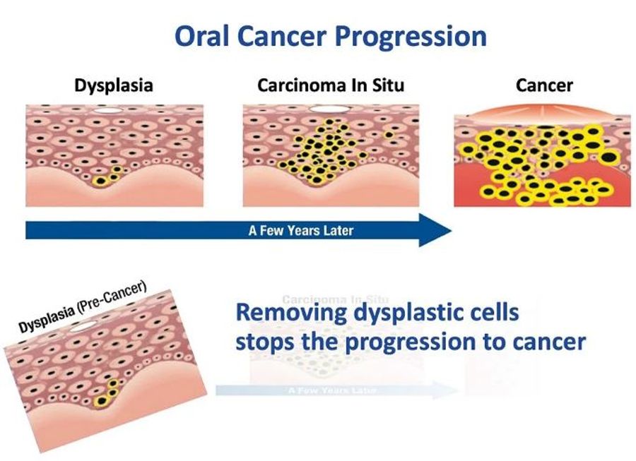 Oralcdx NonInvasive Oral Brush Biopsy With AIEnabled Tissue
