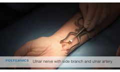 BioPro Modular Thumb Implant patient back to surgery - Video