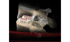 Alamo - Model P - Posterior Lumbar Intervertebral Device