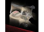 Alamo - Model T - Transforaminal Lumbar Intervertebral Device